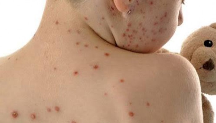 হামের লক্ষণ নিয়ে দুই শিশু হাসপাতালে ভর্তি, আরও একজনকে সিলেটে রেফার