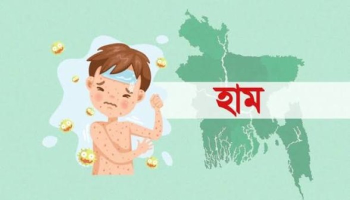 হাম ও হামের উপসর্গ : এ পর্যন্ত মৃত্যু ৭০৮