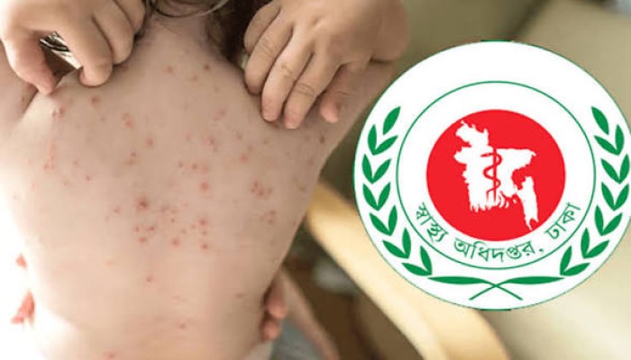 হামের উপসর্গ নিয়ে ৯ মাস বয়সি শিশুর মৃত্যু