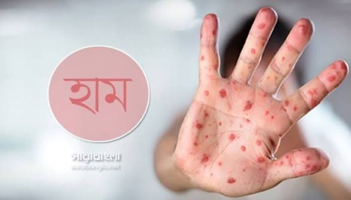 হাম ও উপসর্গে আরও ৫ শিশুর মৃত্যু