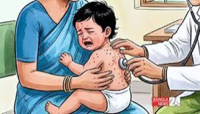 হামের উপসর্গে প্রাণ গেল আরও ৫ শিশুর